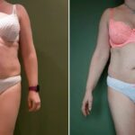 Endermologie - Avant/Après 1