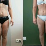 Endermologie - Avant/Après 2