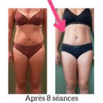 Endermologie - Avant/Après 3