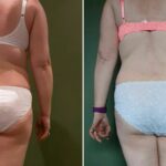 Endermologie - Avant/Après 5