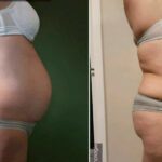 Endermologie - Avant/Après 7