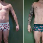 Endermologie - Avant/Après 8