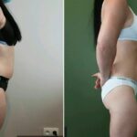 Endermologie - Avant/Après 9