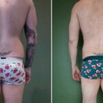 Endermologie - Avant/Après 10