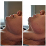 Endermologie - Avant/Après 11