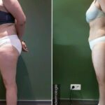 Endermologie - Avant/Après 12