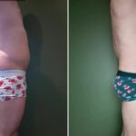 Endermologie - Avant/Après 13