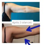 Endermologie - Avant/Après 14