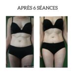 Endermologie - Avant/Après 15