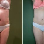 Endermologie - Avant/Après 18