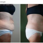 Endermologie - Avant/Après 19
