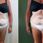 Endermologie - Avant/Après 20