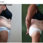 Endermologie - Avant/Après 21