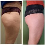 Endermologie - Avant/Après 22