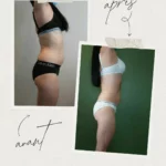 L'endermologie par Sophie_1