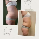 L'endermologie par Sophie_10