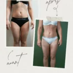 L'endermologie par Sophie_2