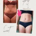 L'endermologie par Sophie_3