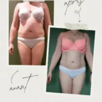 L'endermologie par Sophie_4