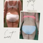 L'endermologie par Sophie_5