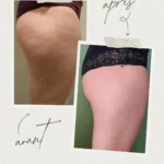 L'endermologie par Sophie_6