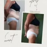 L'endermologie par Sophie_7