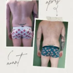 L'endermologie par Sophie_8